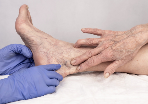 Spider Vein or Varicose Vein Removal/Sclerotherapy (Laser or Injection)