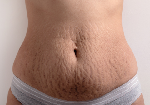 Stretch Marks and Scar Removal