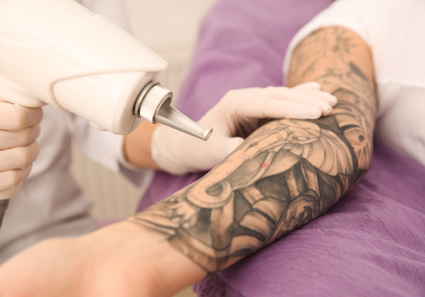 Tattoo Removal